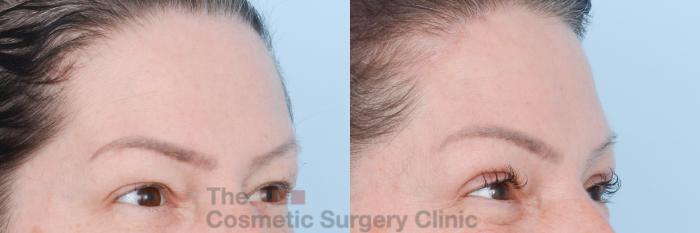 Before & After Brow Lift Case 829 Right Oblique View in Waterloo, Ontario