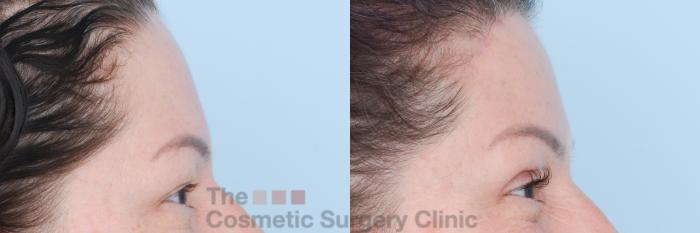 Before & After Brow Lift Case 829 Right Side View in Waterloo, Ontario