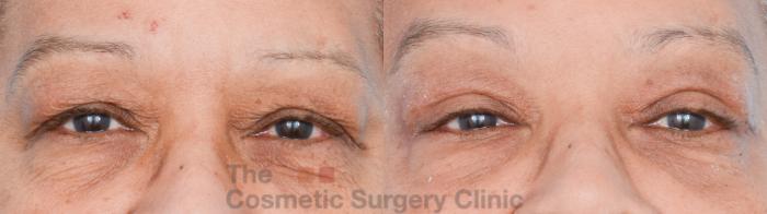 Before & After Eyelid Lift Case 838 Front View in Waterloo, Ontario