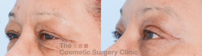 Before & After Eyelid Lift Case 838 Left Oblique View in Waterloo, Ontario