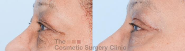 Before & After Eyelid Lift Case 838 Left Side View in Waterloo, Ontario
