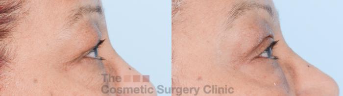 Before & After Eyelid Lift Case 838 Right Side View in Waterloo, Ontario