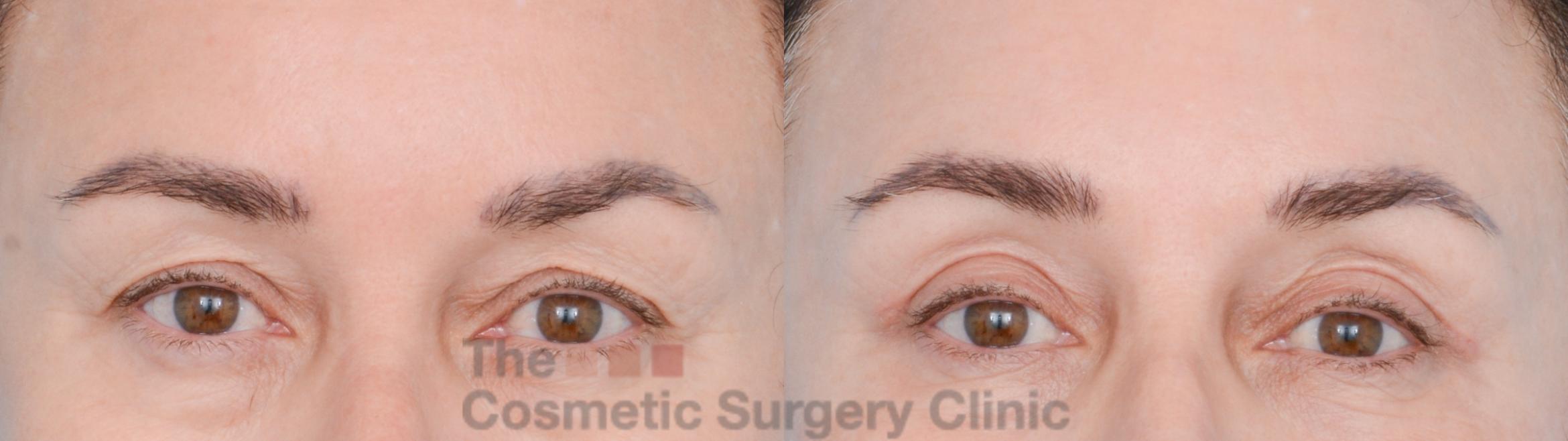 Before & After Eyelid Lift Case 850 Front View in Waterloo, Ontario