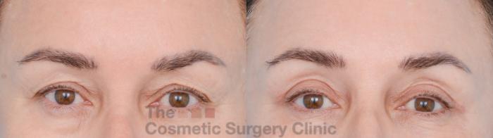 Before & After Eyelid Lift Case 850 Front View in Waterloo, Ontario