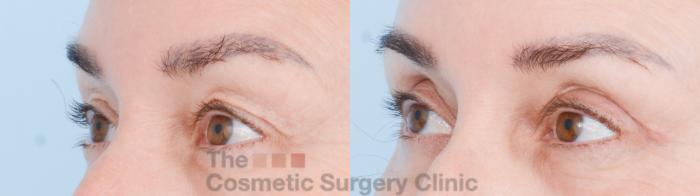 Before & After Eyelid Lift Case 850 Left Oblique View in Waterloo, Ontario