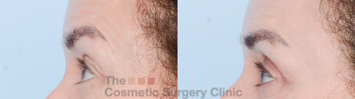Before & After Eyelid Lift Case 850 Left Side View in Waterloo, Ontario