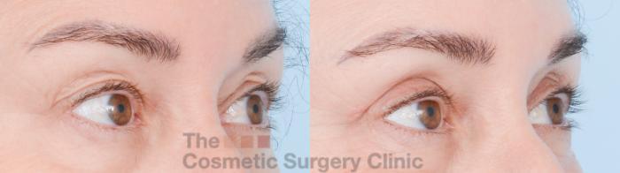 Before & After Eyelid Lift Case 850 Right Oblique View in Waterloo, Ontario