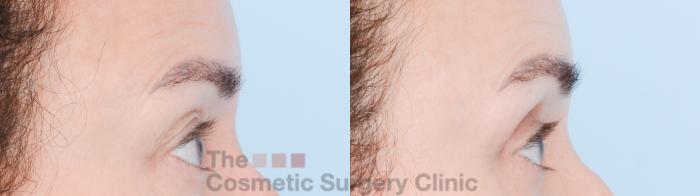Before & After Eyelid Lift Case 850 Right Side View in Waterloo, Ontario