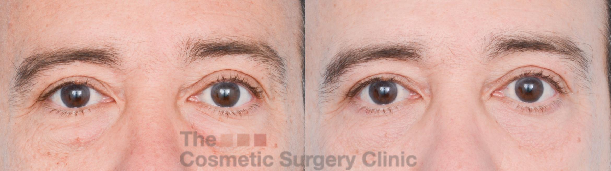 Before & After Eyelid Lift Case 856 Front View in Waterloo, Ontario