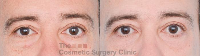 Before & After Eyelid Lift Case 856 Front View in Waterloo, Ontario