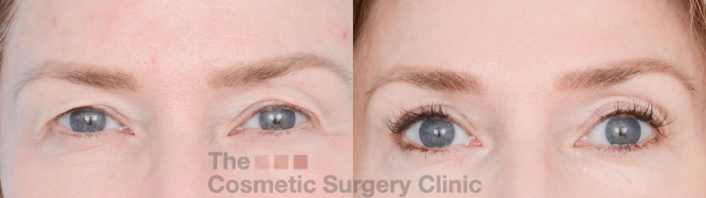 Before & After Eyelid Lift Case 872 Front View in Waterloo, Ontario
