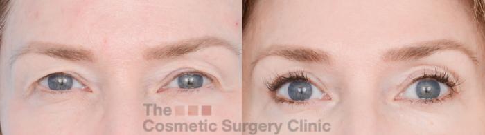 Before & After Eyelid Lift Case 872 Front View in Waterloo, Ontario