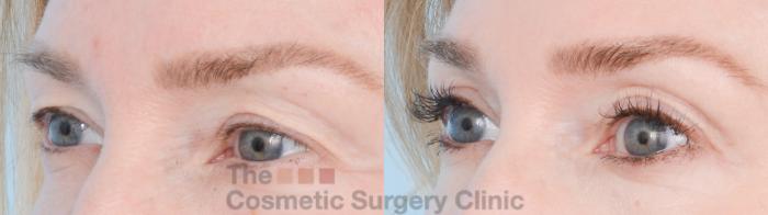 Before & After Eyelid Lift Case 872 Left Oblique View in Waterloo, Ontario
