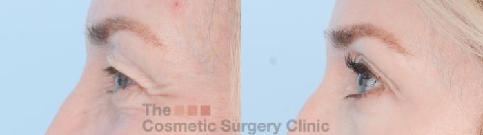 Before & After Eyelid Lift Case 872 Left Side View in Waterloo, Ontario