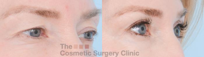Before & After Eyelid Lift Case 872 Right Oblique View in Waterloo, Ontario