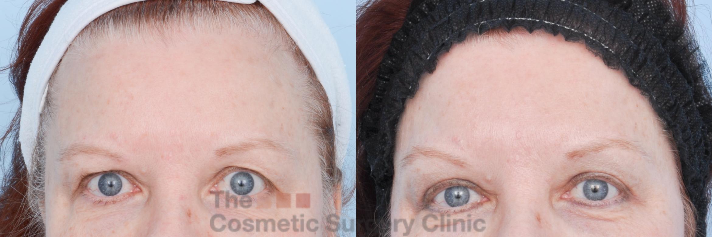 Before & After Eyelid Lift Case 896 Front View in Waterloo, Ontario