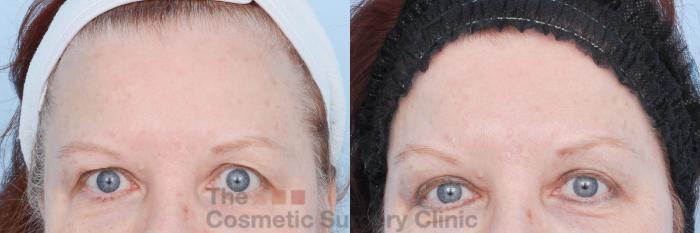 Before & After Eyelid Lift Case 896 Front View in Waterloo, Ontario