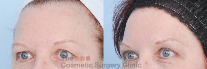 Before & After Eyelid Lift Case 896 Left Oblique View in Waterloo, Ontario