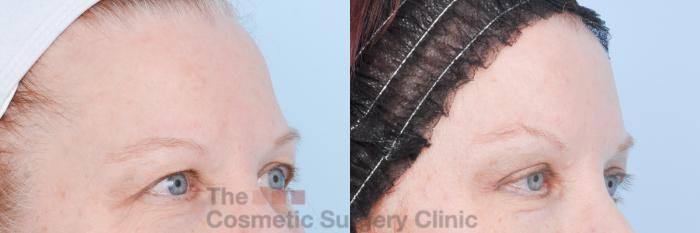 Before & After Eyelid Lift Case 896 Right Oblique View in Waterloo, Ontario
