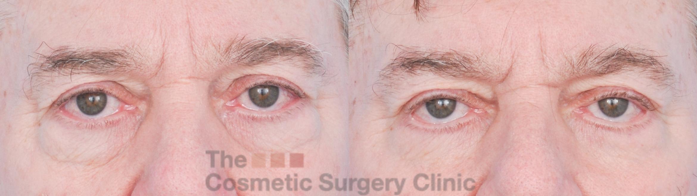 Before & After Eyelid Lift Case 916 Front View in Waterloo, Ontario