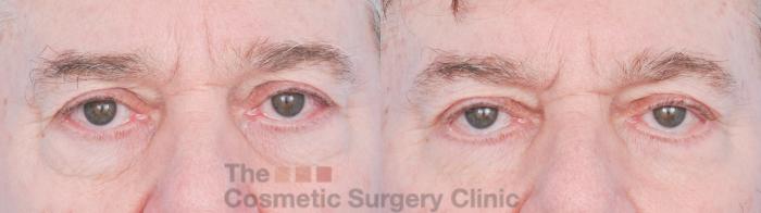 Before & After Eyelid Lift Case 916 Front View in Waterloo, Ontario