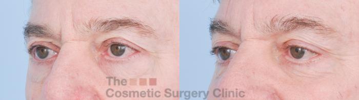 Before & After Eyelid Lift Case 916 Left Oblique View in Waterloo, Ontario