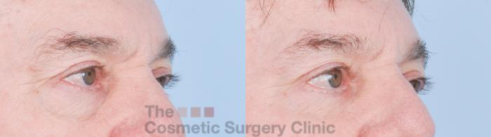 Before & After Eyelid Lift Case 916 Right Oblique View in Waterloo, Ontario