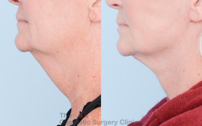 Before & After Facelift Case 852 Left Side View in Waterloo, Ontario