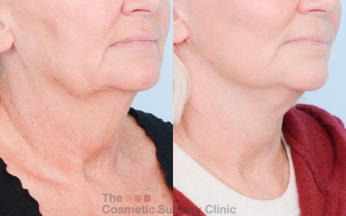 Before & After Facelift Case 852 Right Oblique View in Waterloo, Ontario
