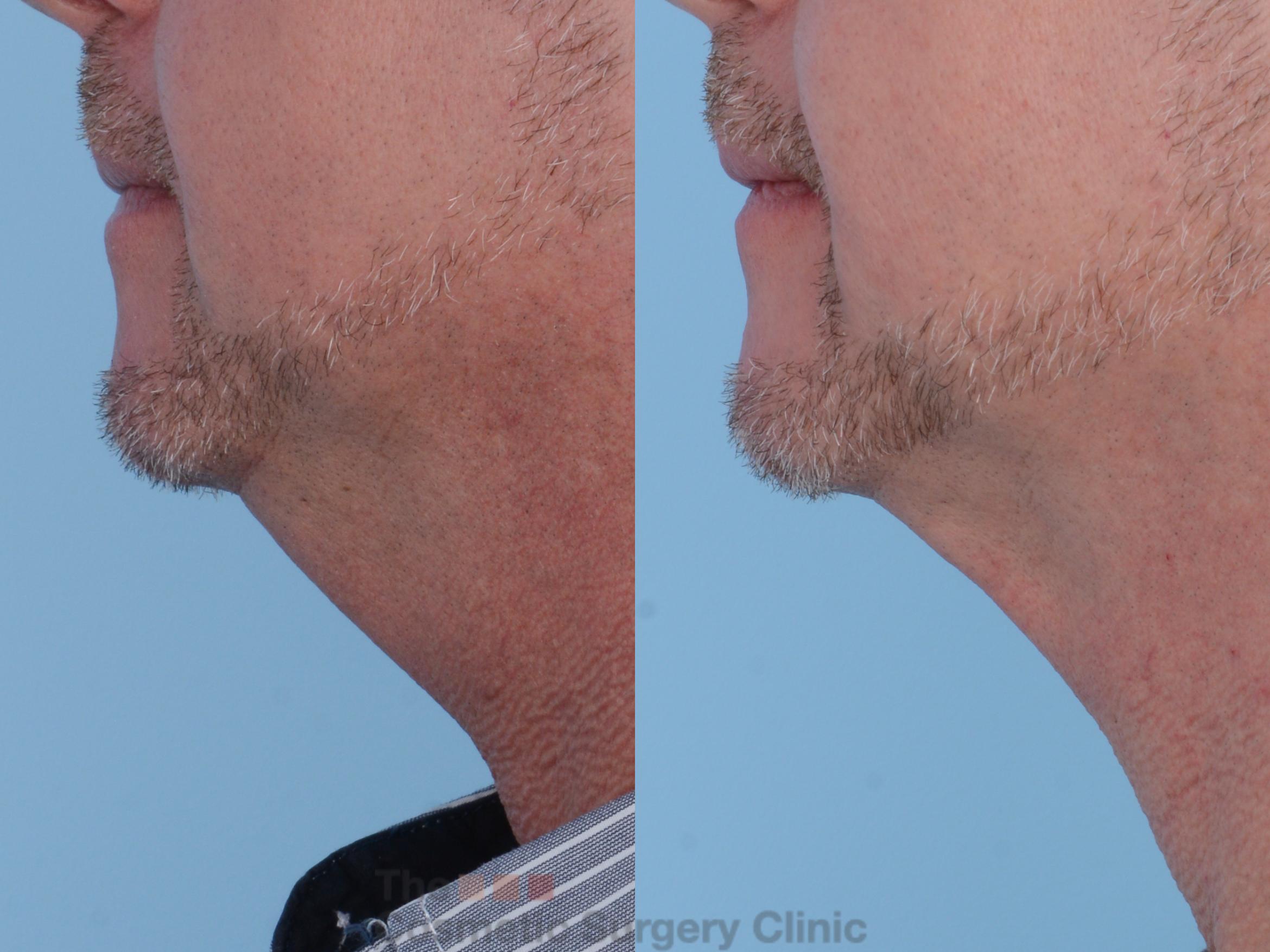 Before & After FaceTite Case 212 View #3 View in Waterloo, Ontario
