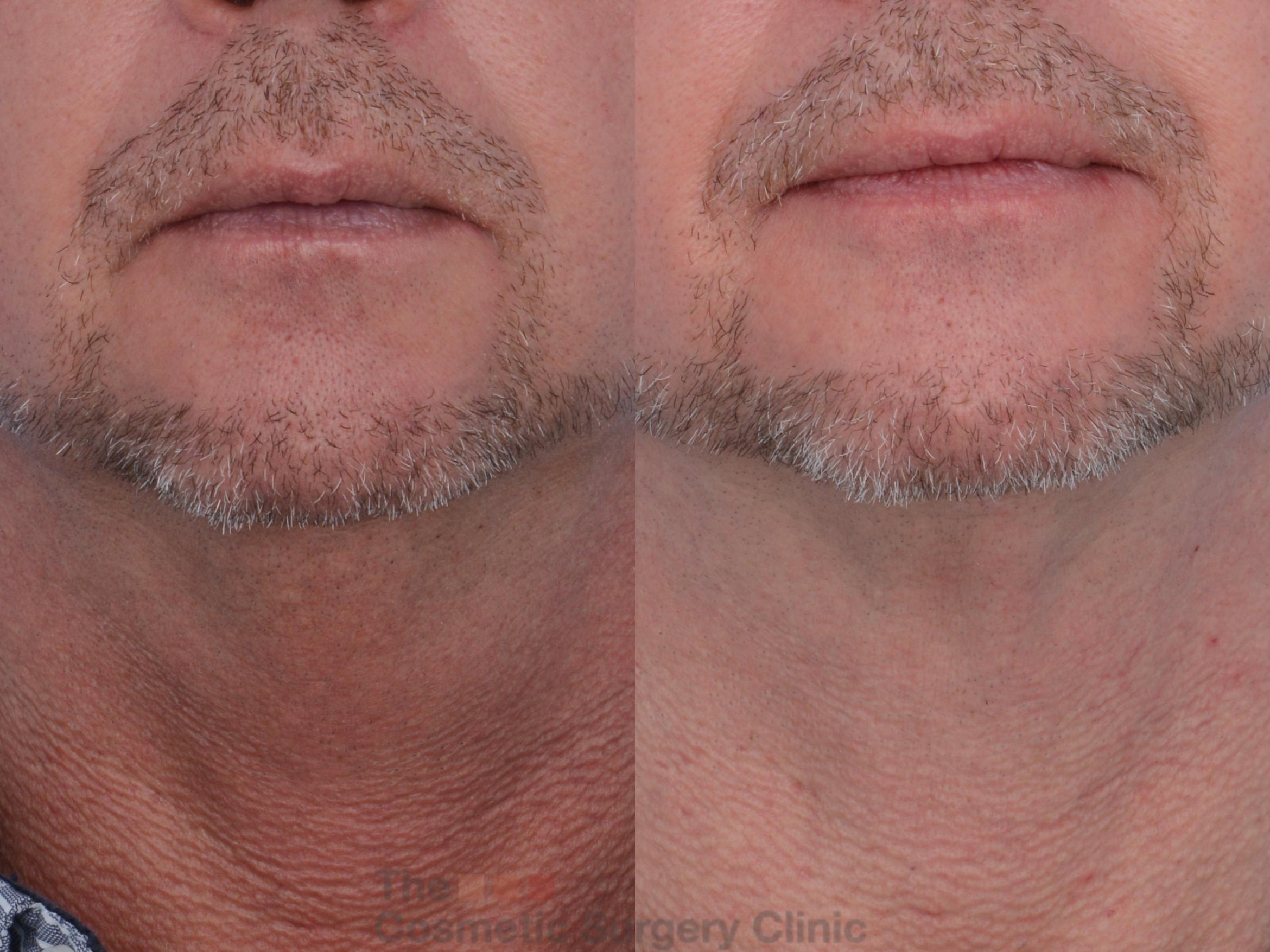 Before & After FaceTite Case 212 View #5 View in Waterloo, Ontario