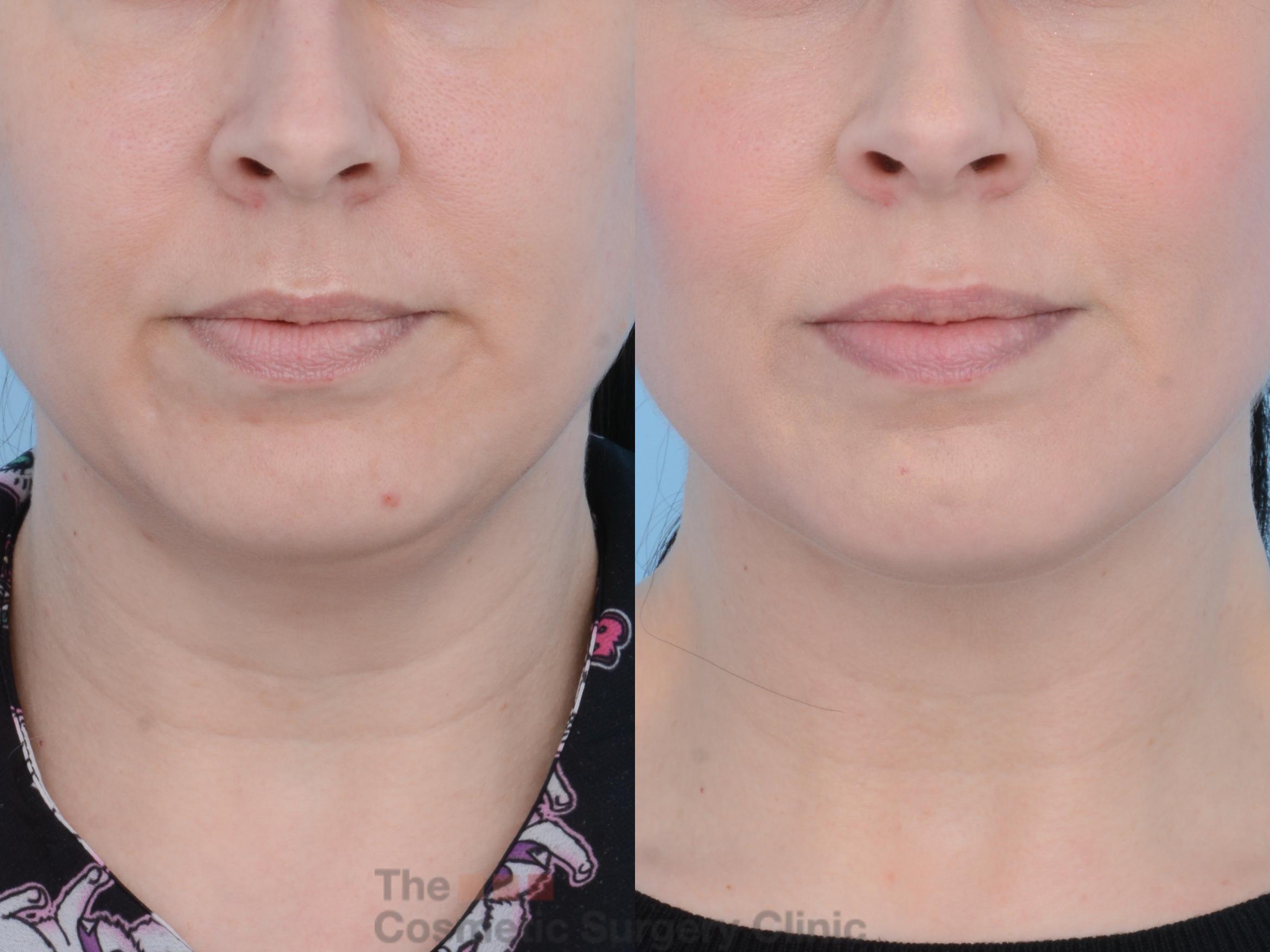 Before & After FaceTite Case 223 View #3 View in Waterloo, Ontario