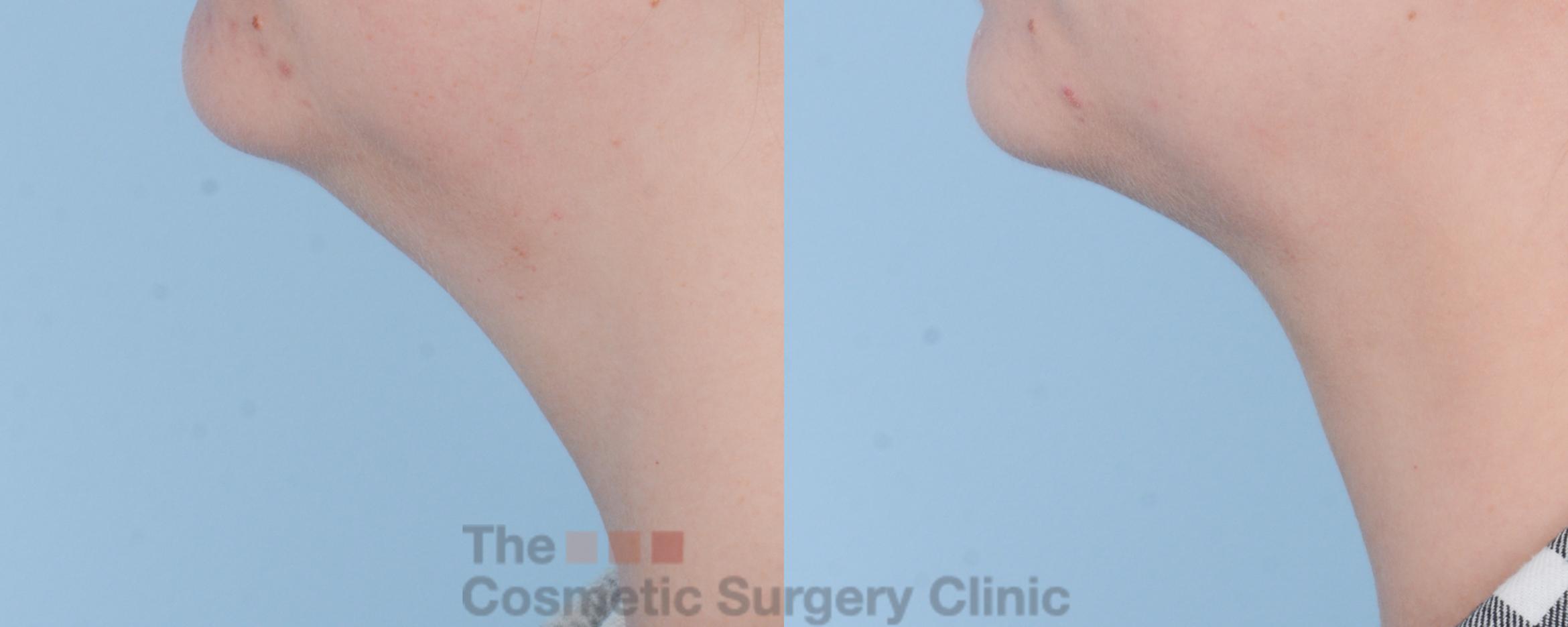 Before & After FaceTite Case 509 View #2 View in Waterloo, Ontario