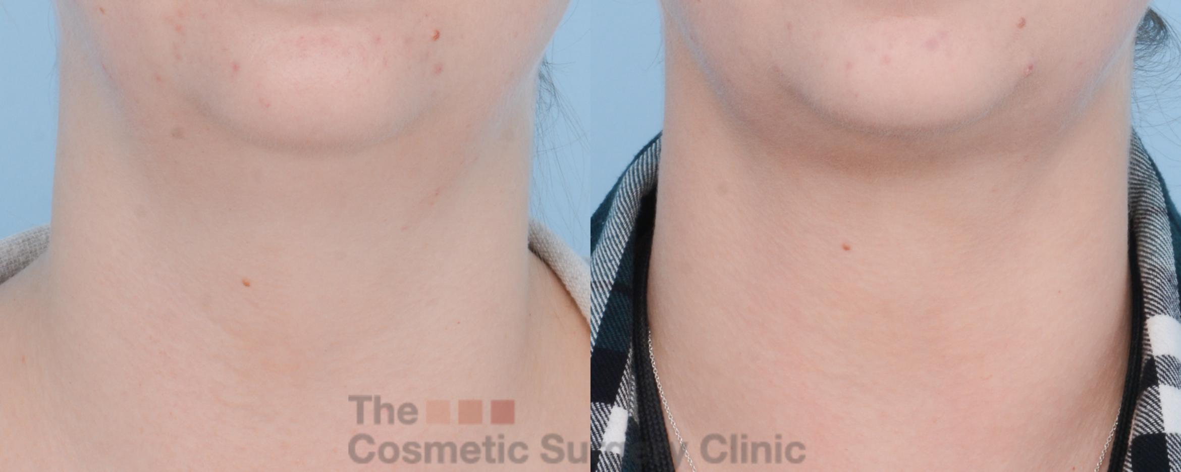 Before & After FaceTite Case 509 View #5 View in Waterloo, Ontario