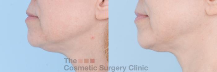 Before & After FaceTite Case 598 View #2 View in Waterloo, Ontario