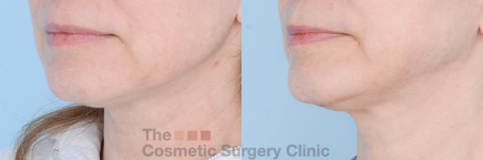 Before & After FaceTite Case 598 View #3 View in Waterloo, Ontario