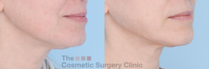 Before & After FaceTite Case 598 View #4 View in Waterloo, Ontario