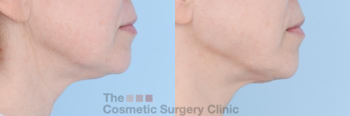 Before & After FaceTite Case 598 View #5 View in Waterloo, Ontario