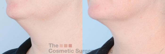 Before & After FaceTite Case 842 Left Oblique View in Waterloo, Ontario