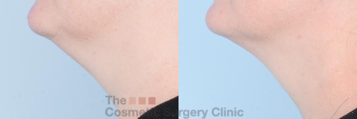 Before & After FaceTite Case 842 Left Side View in Waterloo, Ontario