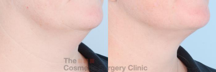 Before & After FaceTite Case 842 Right Oblique View in Waterloo, Ontario