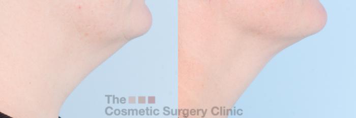 Before & After FaceTite Case 842 Right Side View in Waterloo, Ontario
