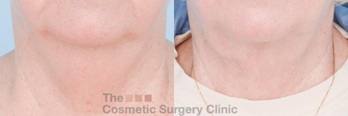 Before & After FaceTite Case 848 Front View in Waterloo, Ontario