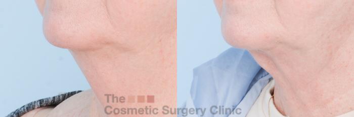 Before & After FaceTite Case 848 Left Oblique View in Waterloo, Ontario