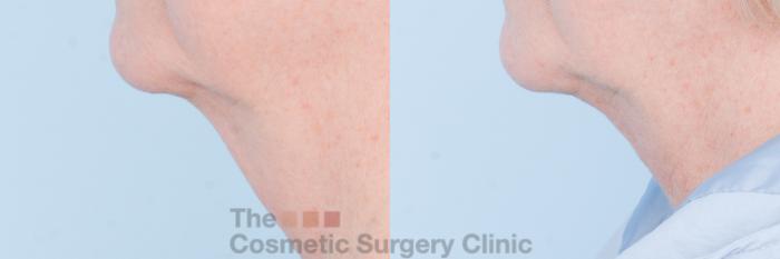 Before & After FaceTite Case 848 Left Side View in Waterloo, Ontario