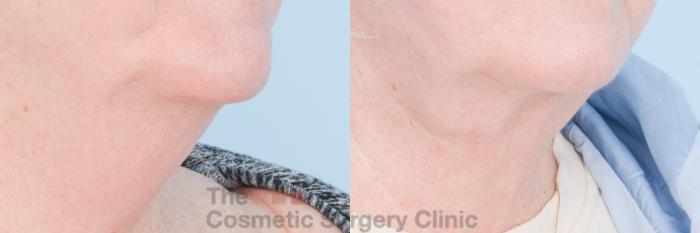 Before & After FaceTite Case 848 Right Oblique View in Waterloo, Ontario
