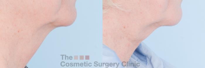 Before & After FaceTite Case 848 Right Side View in Waterloo, Ontario