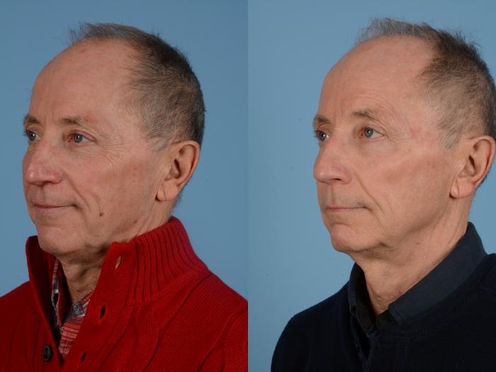 Before & After Facial Rejuvenation  and Skincare Case 114 View #2 View in Waterloo, Ontario