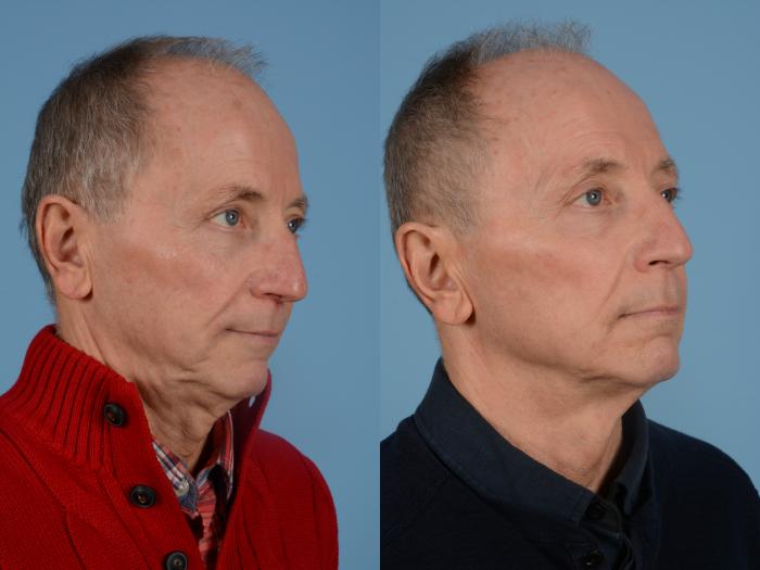 Before & After Facial Rejuvenation  and Skincare Case 114 View #3 View in Waterloo, Ontario