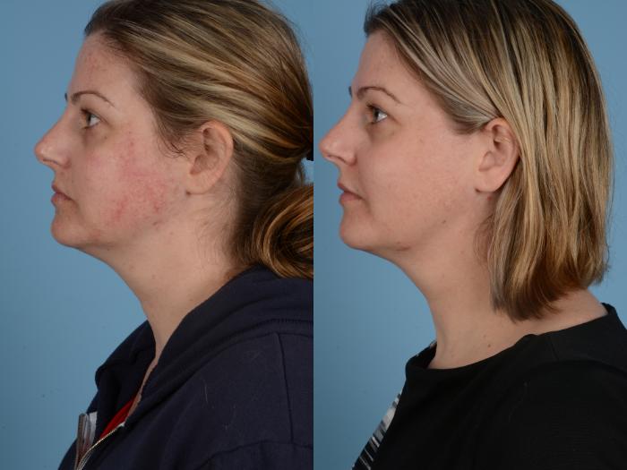 Before & After Facial Rejuvenation  and Skincare Case 117 View #2 View in Waterloo, Ontario